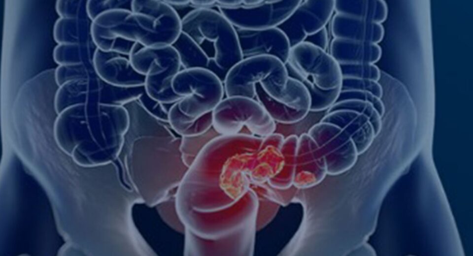 Pacientes com câncer colorretal são diagnosticados em estágio avançado