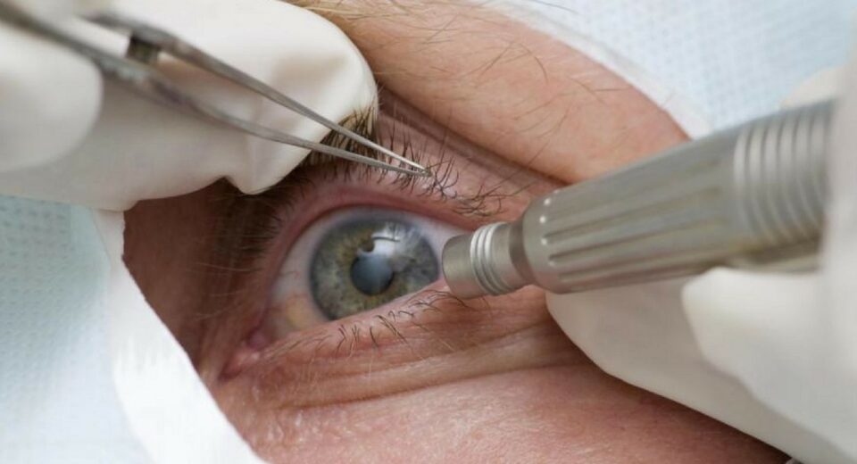 Lula faz cirurgia de catarata; entenda a doença e o procedimento