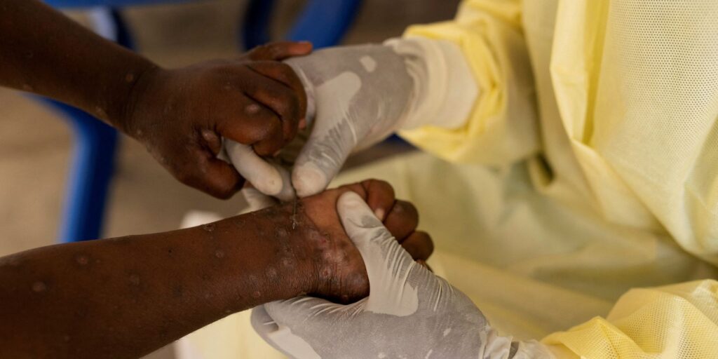 Brasil registra 88 casos de Mpox em 2026; saiba como evitar a doença