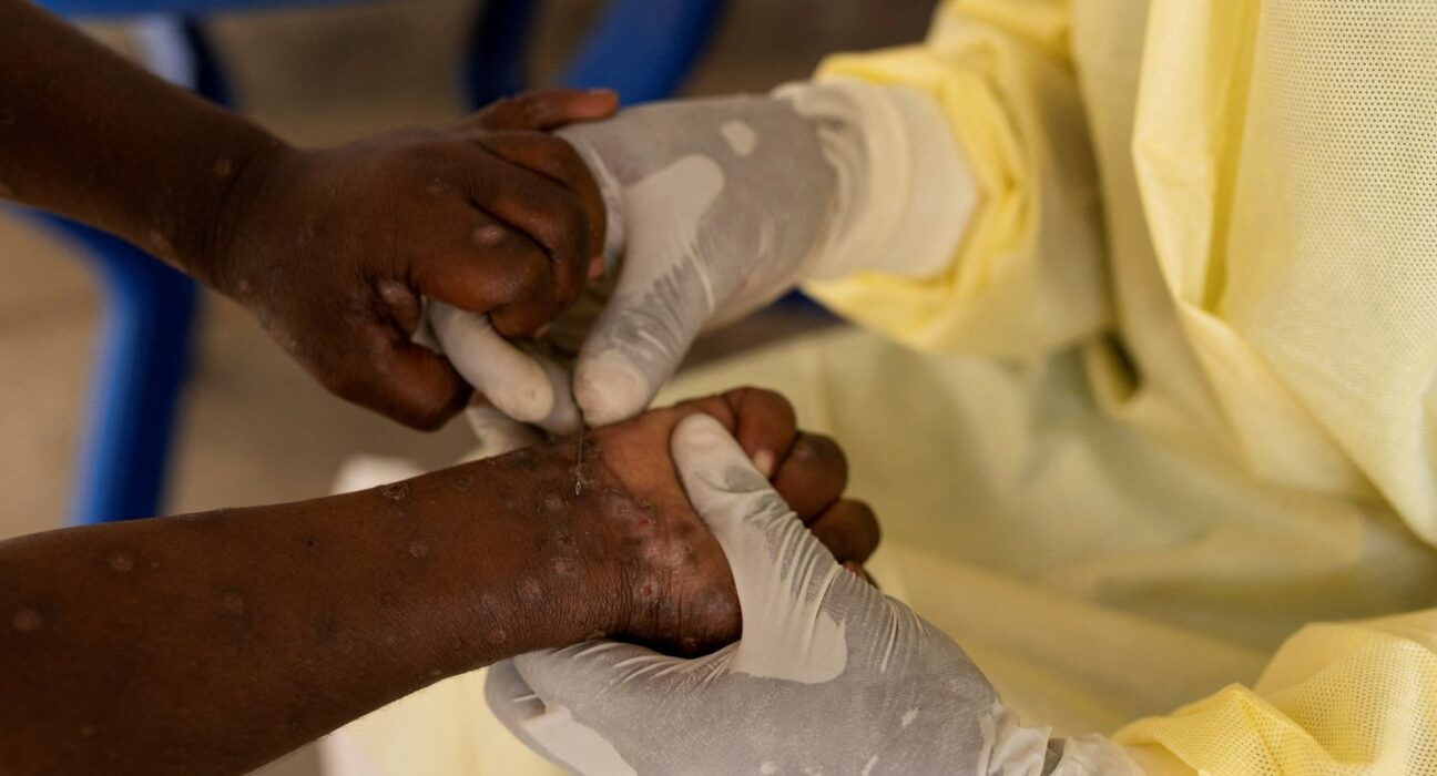 Brasil registra 88 casos de Mpox em 2026; saiba como evitar a doença