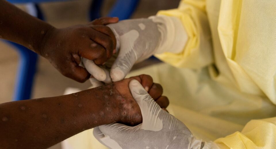 Brasil registra 88 casos de Mpox em 2026; saiba como evitar a doença