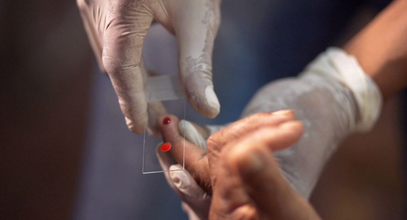 SUS começa a usar novo tratamento contra a malária em crianças