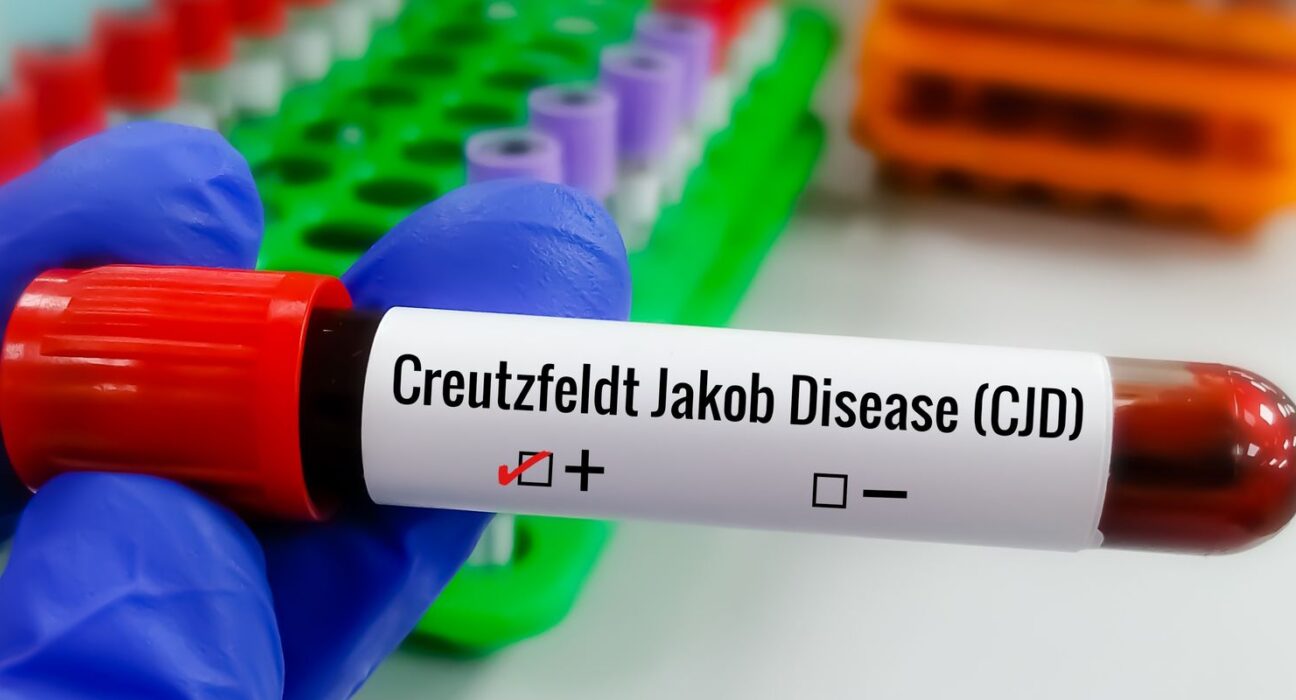 Entenda Doença de Creutzfeldt-Jakob e busca por tratamento