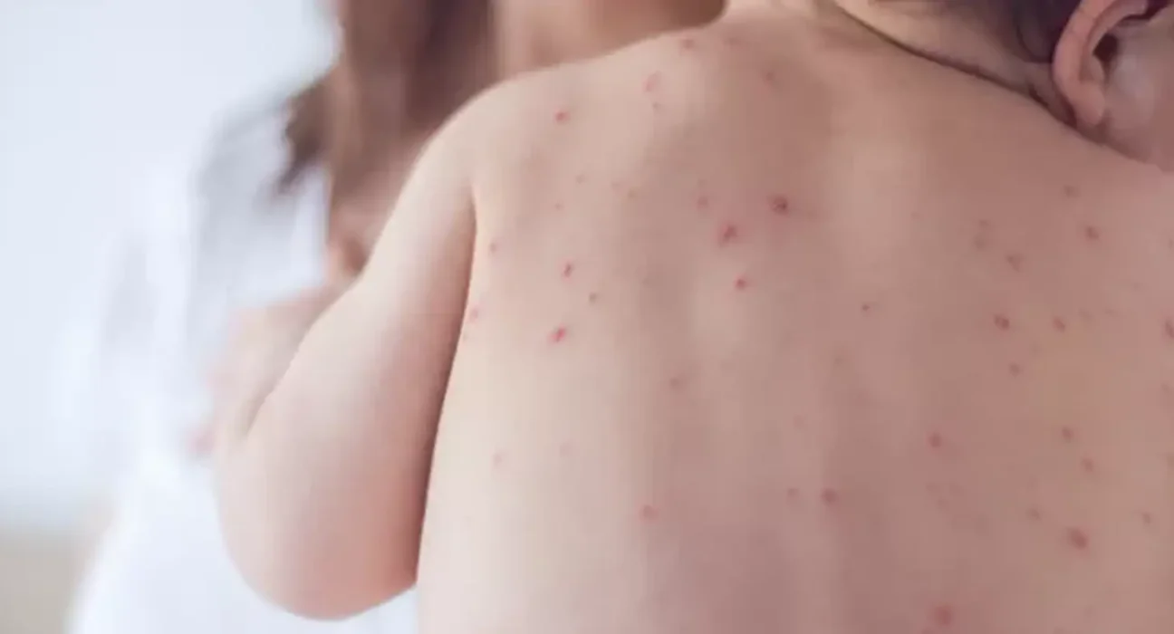 Estado de São Paulo reforça necessidade de vacinação contra o sarampo