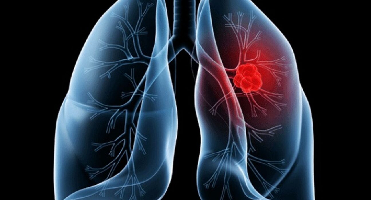 Saiba o que é adenocarcinoma pulmonar, câncer que atinge o papa